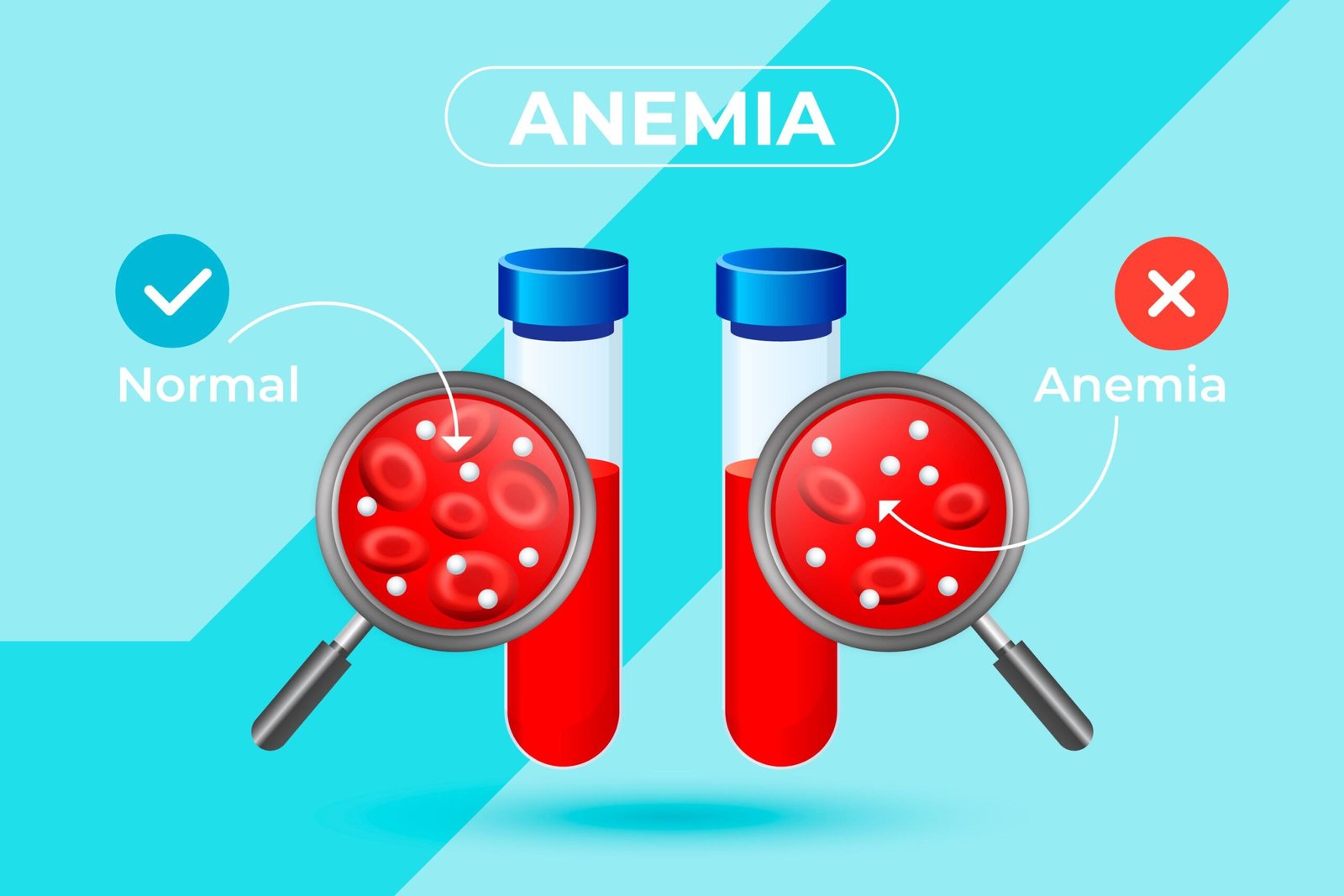 Anemia: A Comprehensive Guide from a Hematologist